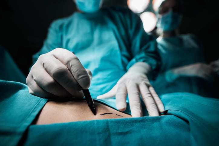 Close up of a plastic surgeon marking skin for surgery.