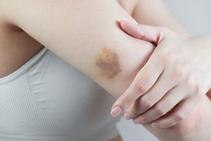 woman with bruised arm