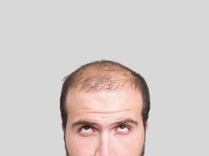 Judge Rules Calling Men Bald Is Sexual Harassment