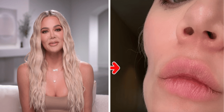 khloe kardashian cheek filler