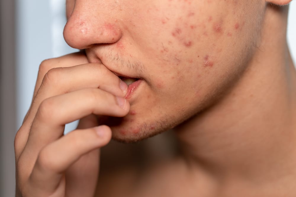 A young man with facial acne.