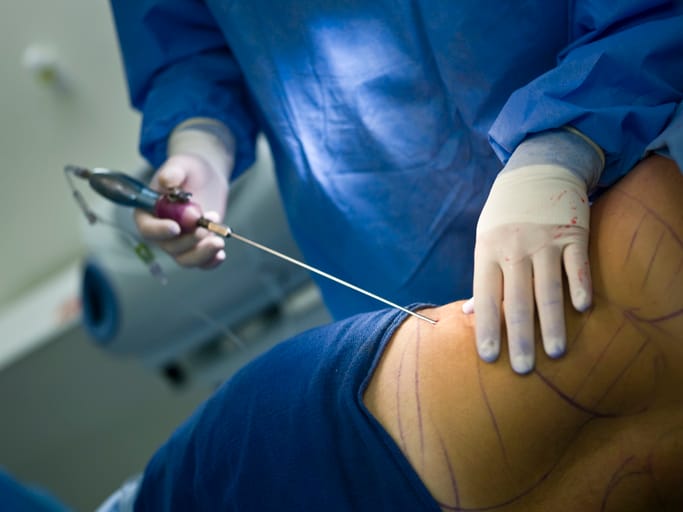 liposuction procedure