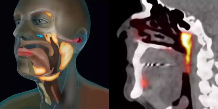 tubarial salivary gland scan