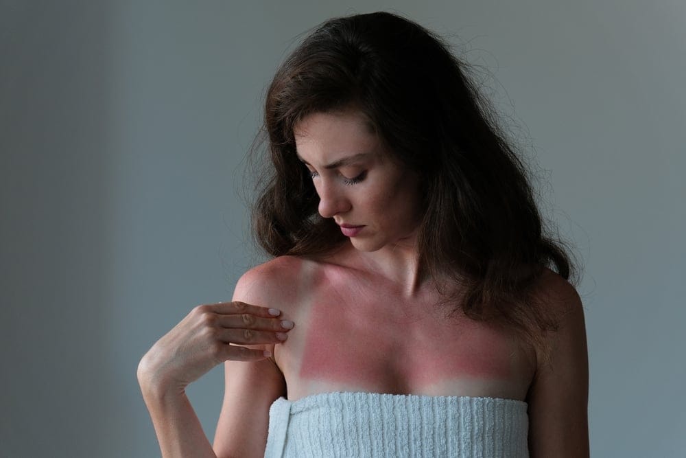 Woman with severe sunburn.