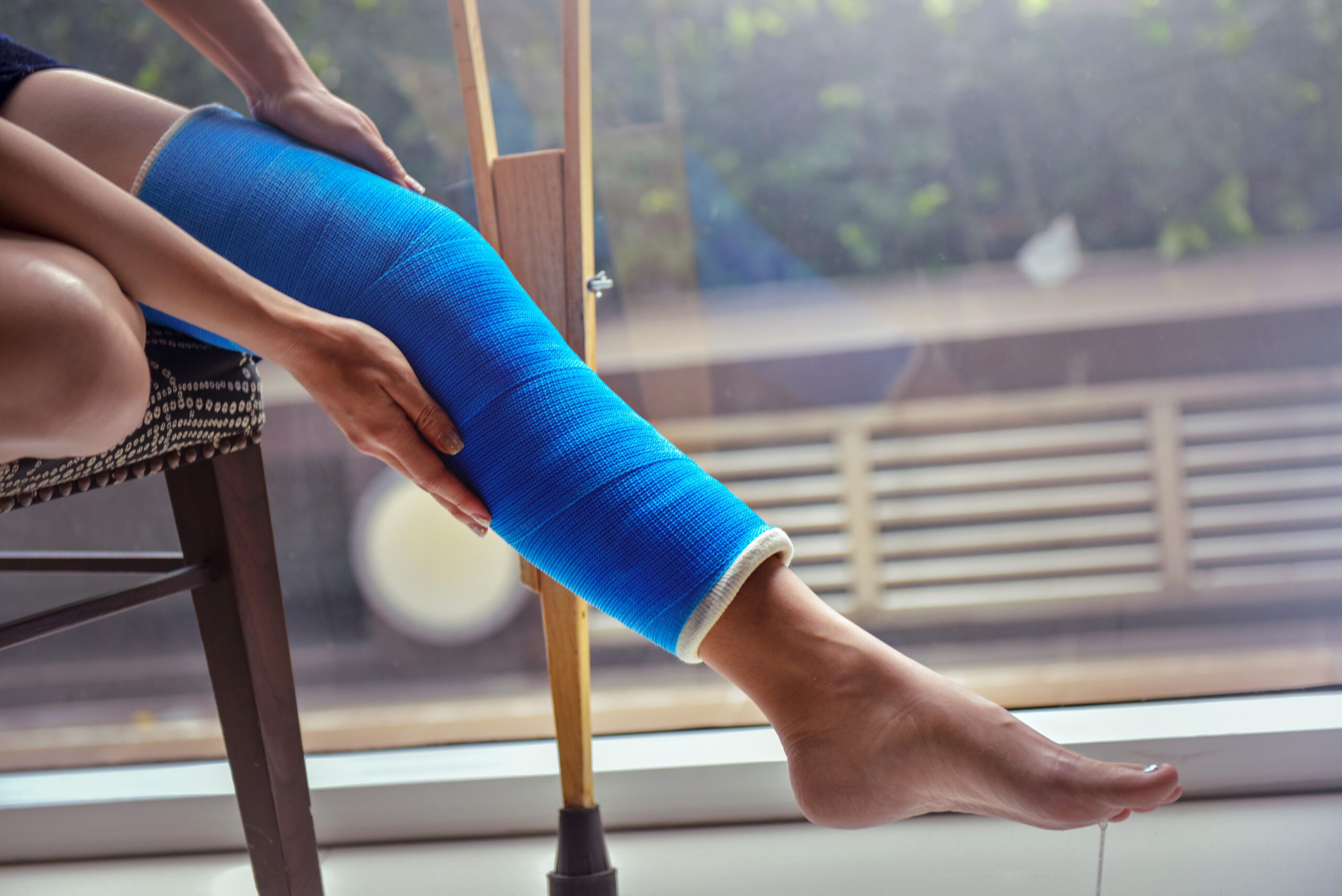 Woman with a bandaged leg cast after an injury.