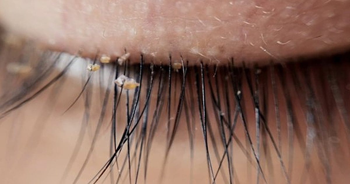 People Are Getting Lash Lice From Eyelash Extensions, Doctors Say