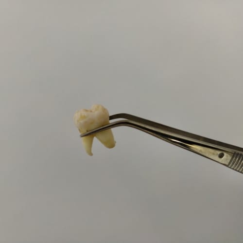 Man Pulls Out Own Teeth With Rusty Pliers After Being Unable To Get Dentist Appointment