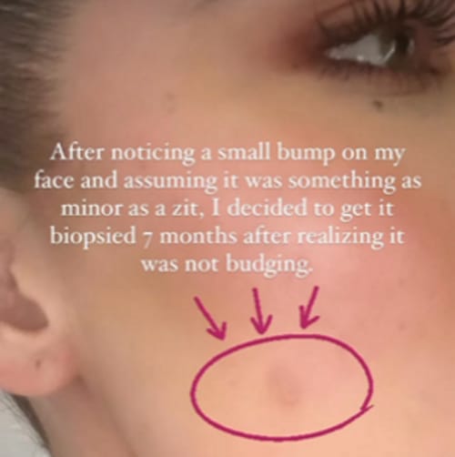 Khloe Kardashian Has Tumor Removed From Her Face 20 Years After Skin Cancer Scare
