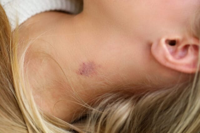 woman's neck with hickey