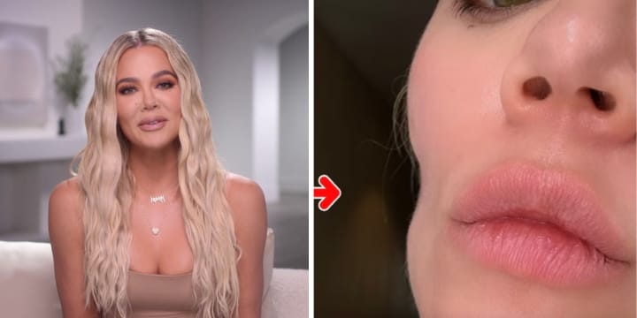 Khloe Kardashian Opens Up About Cosmetic Procedure She Underwent After Health Scare
