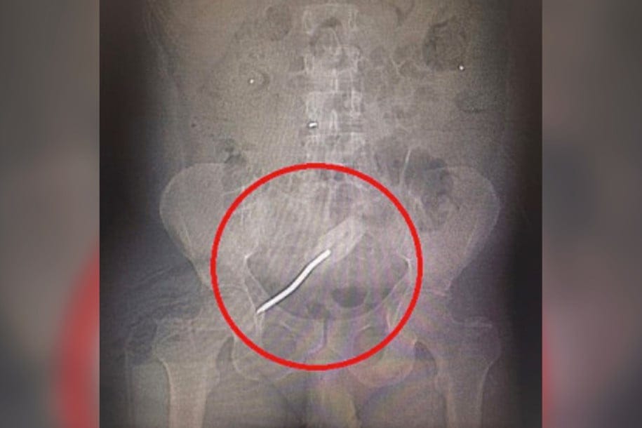 Doctors Discover 8 Inch Screwdriver In Man’s Rectum After He Comes In With Severe Stomach Pain
