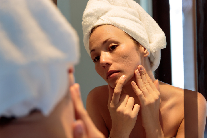Woman looking her acne scars on the mirror.
