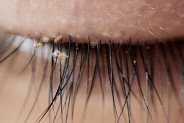 People Are Getting Lash Lice From Eyelash Extensions, Doctors Say