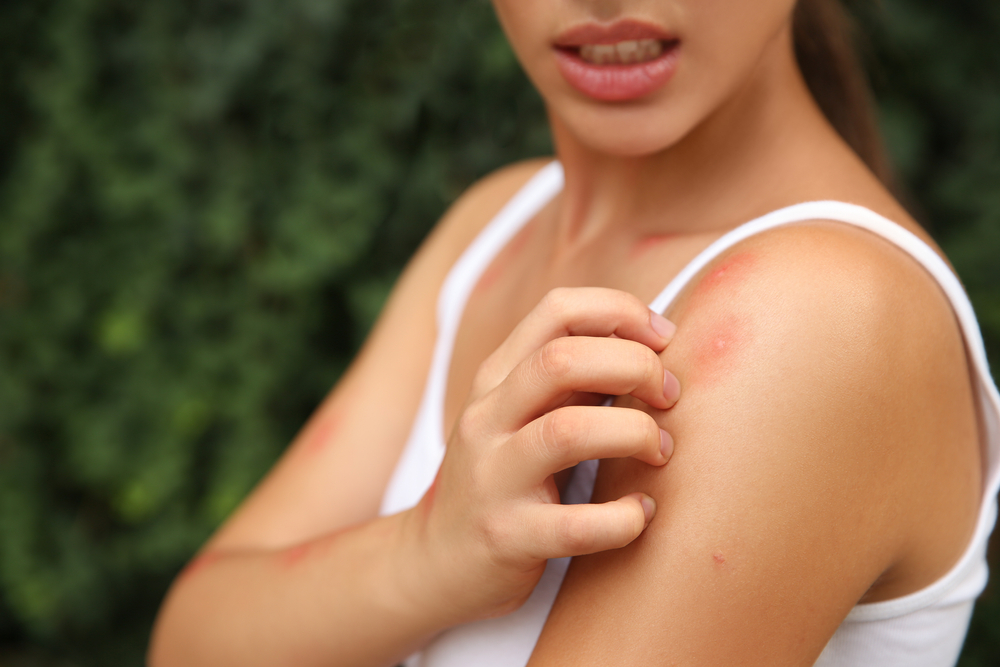 Woman scratching an insect or bug bite.